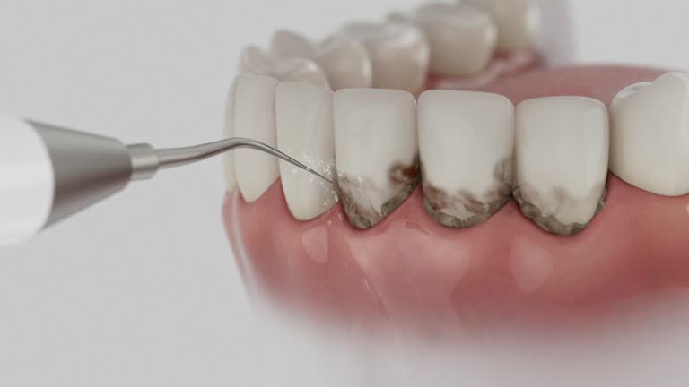 Reliable Wisdom Tooth Removal contractor in Benton County County, TN by Dentist Open Now